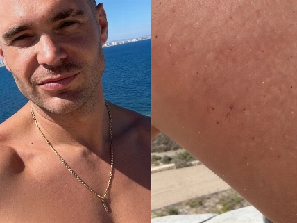 Cristian Suescun, obligado a ir de urgencias tras una picadura en la playa Español.News
