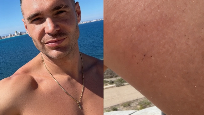 Cristian Suescun, obligado a ir de urgencias tras una picadura en la playa Español.News